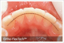 orthodontic retention